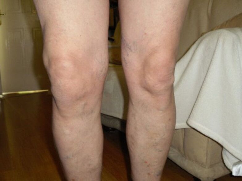 gezonde knie en artrose van het kniegewricht